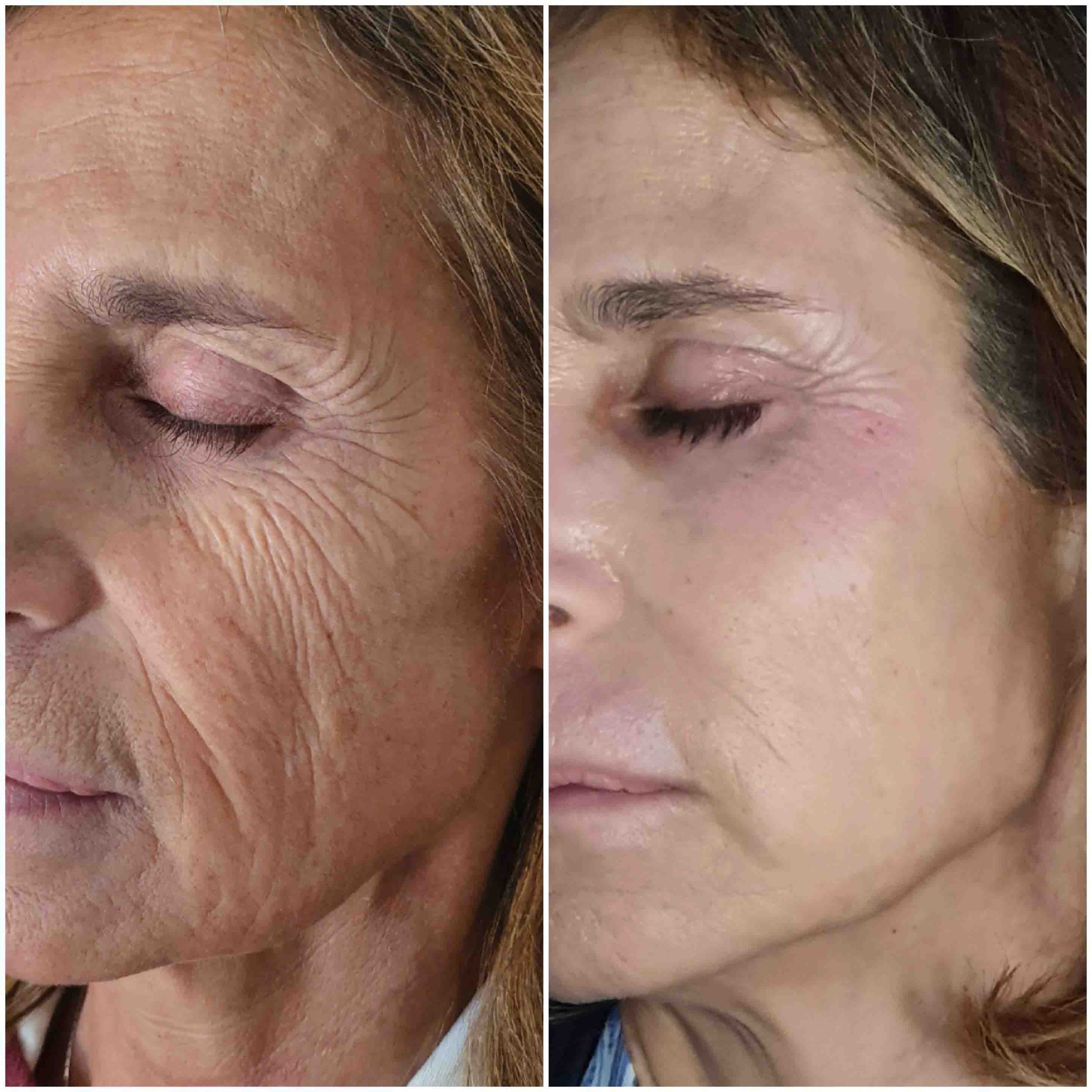 Foto antes y después Plexr pro medicina estética madrid medicina estética chamberí medico estético madrid