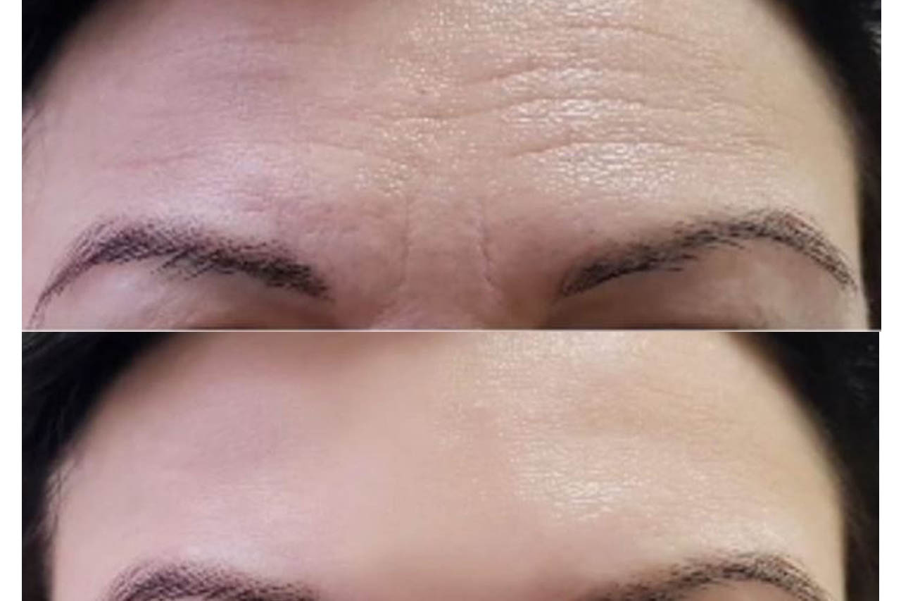 eliminar-arruga-en-la-frente-medicina-estetica-madrid