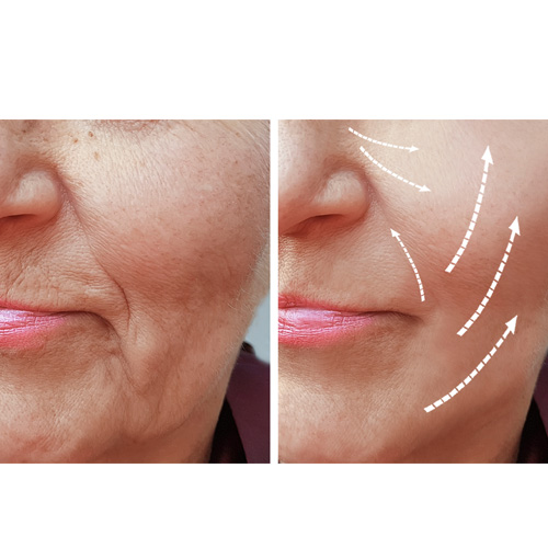 aumento de pómulo medicina estética madrid aumento de pómulo medicina estética madrid